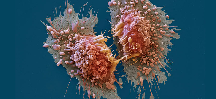 Οι επιστήμονες τον εντόπισαν – Αυτός είναι ο «σούπερ δολοφόνος» όλων των καρκινικών κυττάρων