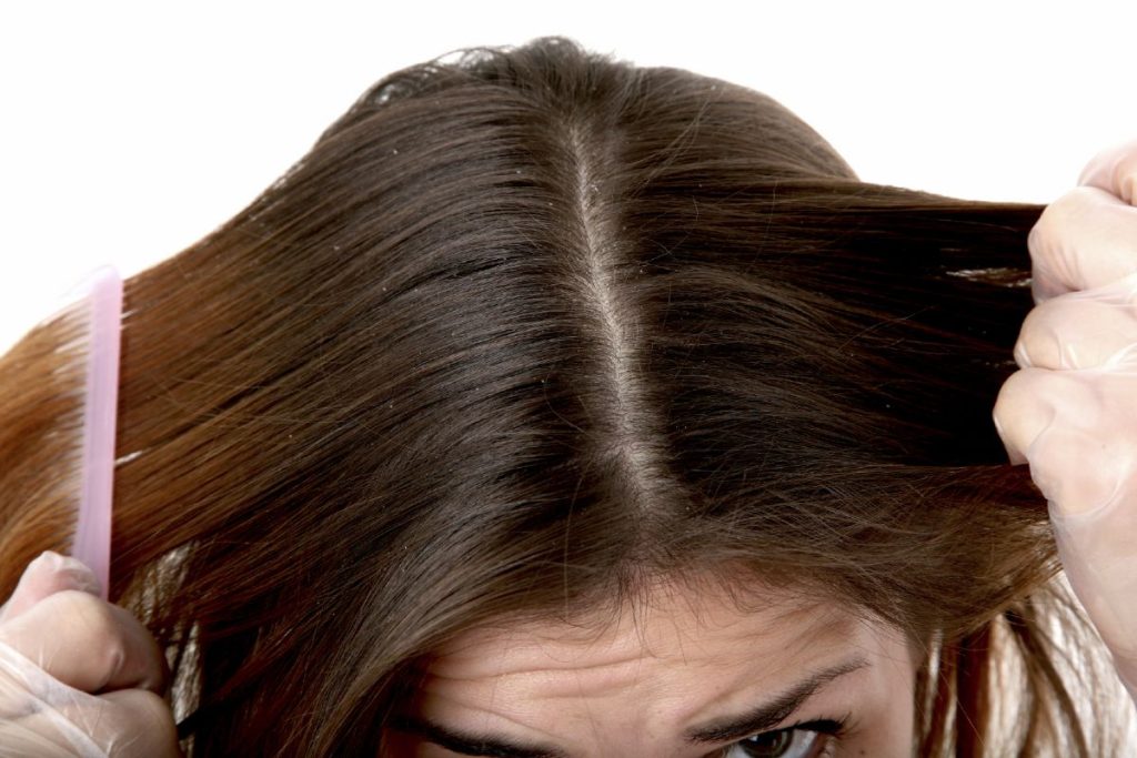 Άσπρες νιφάδες στα μαλλιά: Πότε είναι πιτυρίδα και πότε ξηροδερμία