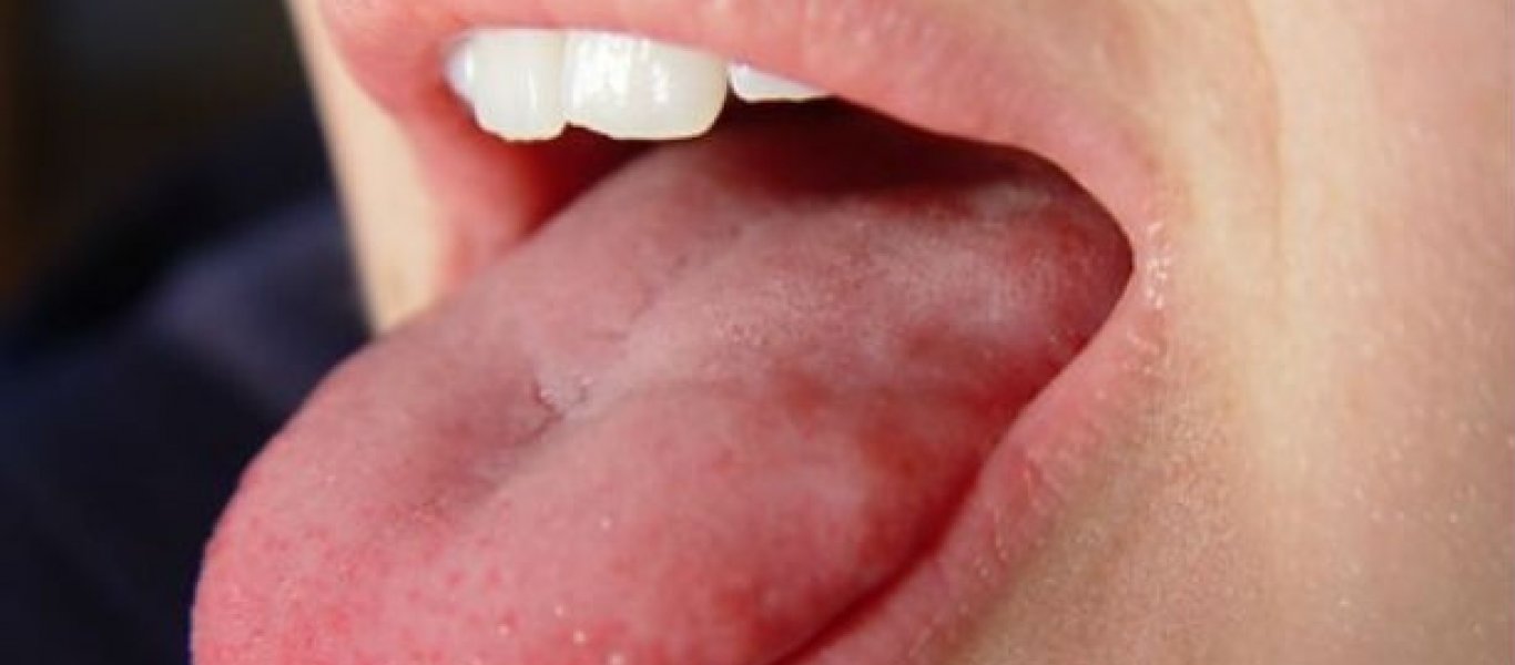 Πρησμένη γλώσσα: Αυτά είναι τα πιθανά σοβαρά αίτια