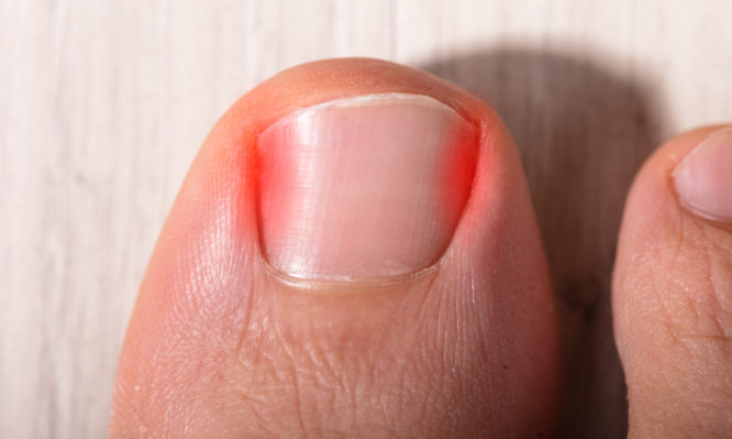 Νύχι που μπαίνει στο δέρμα: Τα σωστά βήματα αντιμετώπισης