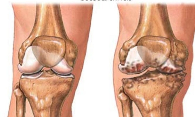 Οστεοαρθρίτιδα ισχίου-γόνατος: Γιατί αυξάνει τον καρδιαγγειακό κίνδυνο;