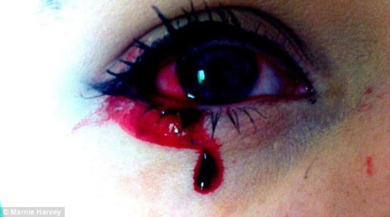 Μυστήριο για τους γιατρούς τα δάκρυα από αίμα ενός 22χρονου