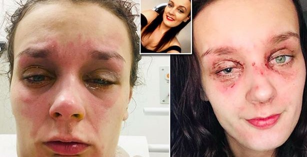 Έφηβη τυφλώθηκε από έκρηξη αυγού στο πρόσωπό της – Η συνήθεια να μαγειρεύει στα μικροκύματα της στέρησε την όραση (φωτο)