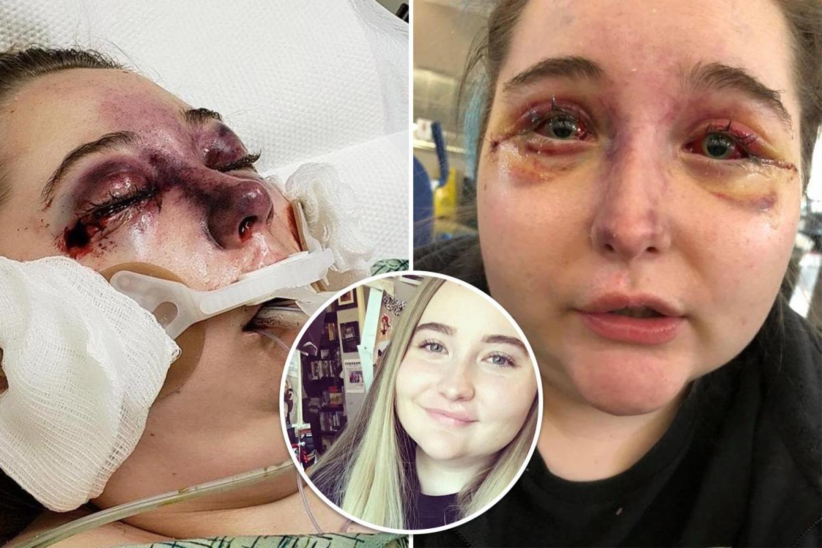 Έφηβη έχασε την όρασή της από μυστήρια ασθένεια – Ματώνουν και πρήζονται τα μάτια της (φωτο – βίντεο)