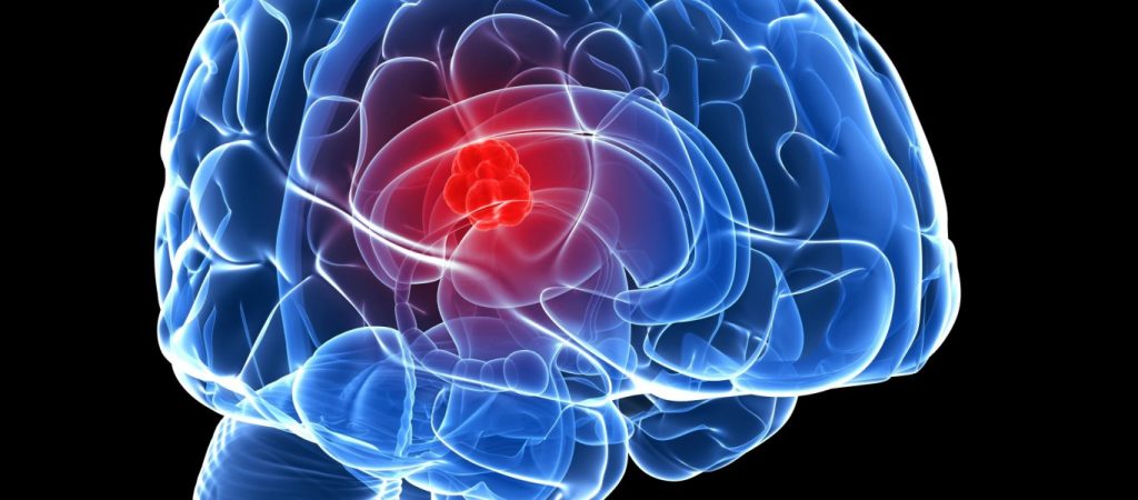 Μίνι εγκεφαλικό: Μεγάλη προσοχή σε αυτά τα πρώιμα συμπτώματα