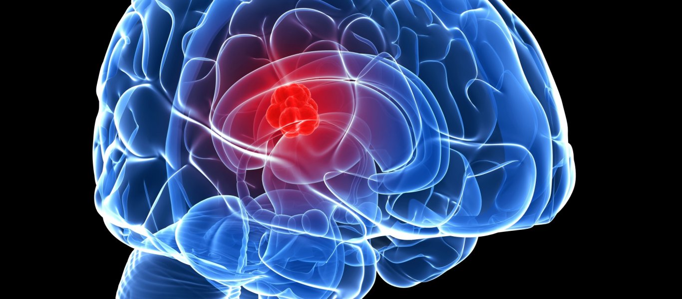 Μίνι εγκεφαλικό: Μεγάλη προσοχή σε αυτά τα πρώιμα συμπτώματα