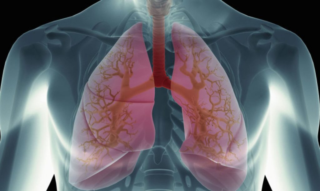 Προσοχή στα συμπτώματα που «δείχνουν» πνευμονικό οίδημα – Τι πρέπει να κάνετε άμεσα