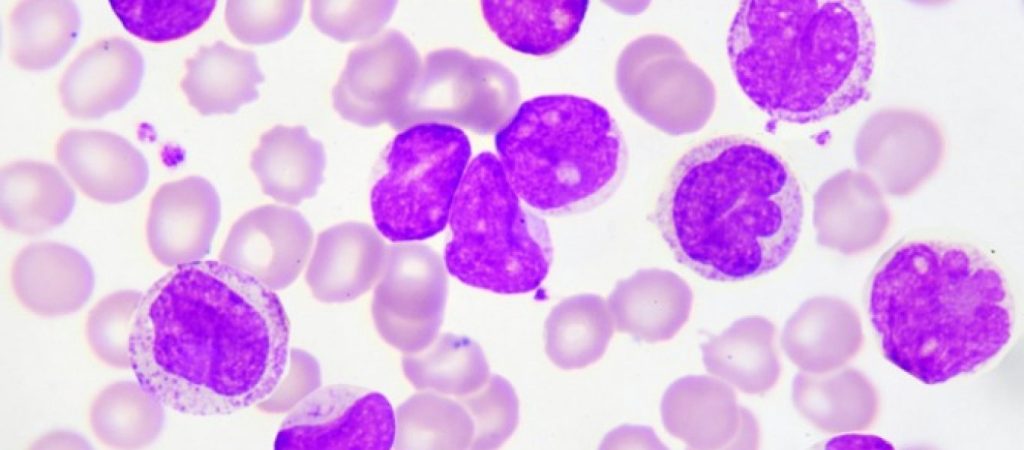 Λευχαιμία- λέμφωμα: Ποιες είναι οι διαφορές- Τι πρέπει να ξέρετε