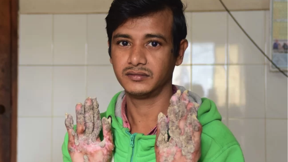 Μπαγκλαντές: Ο άνθρωπος-δέντρο και πάλι στο χειρουργείο – Προσοχή σκληρές εικόνες στο βίντεο