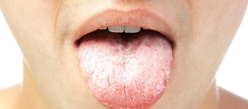 Αν δείτε αυτό στη γλώσσα σας πρέπει να πάτε αμέσως στο γιατρό!