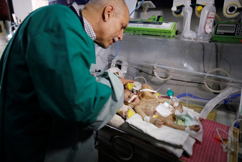 Προχωρά ο διαχωρισμός για σιαμαία βρέφη στην Υεμένη (φωτο-βίντεο)