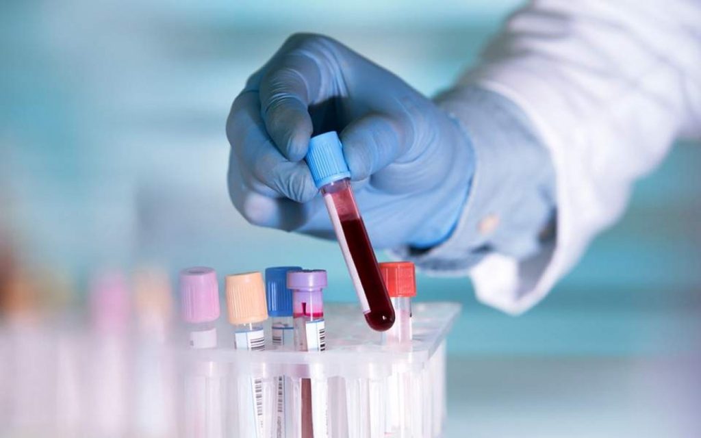 Ερευνητές βρήκαν μέθοδο για να εντοπίζουν με τεστ αίματος τη νόσο Αλτσχάιμερ πριν εμφανιστούν τα συμπτώματα