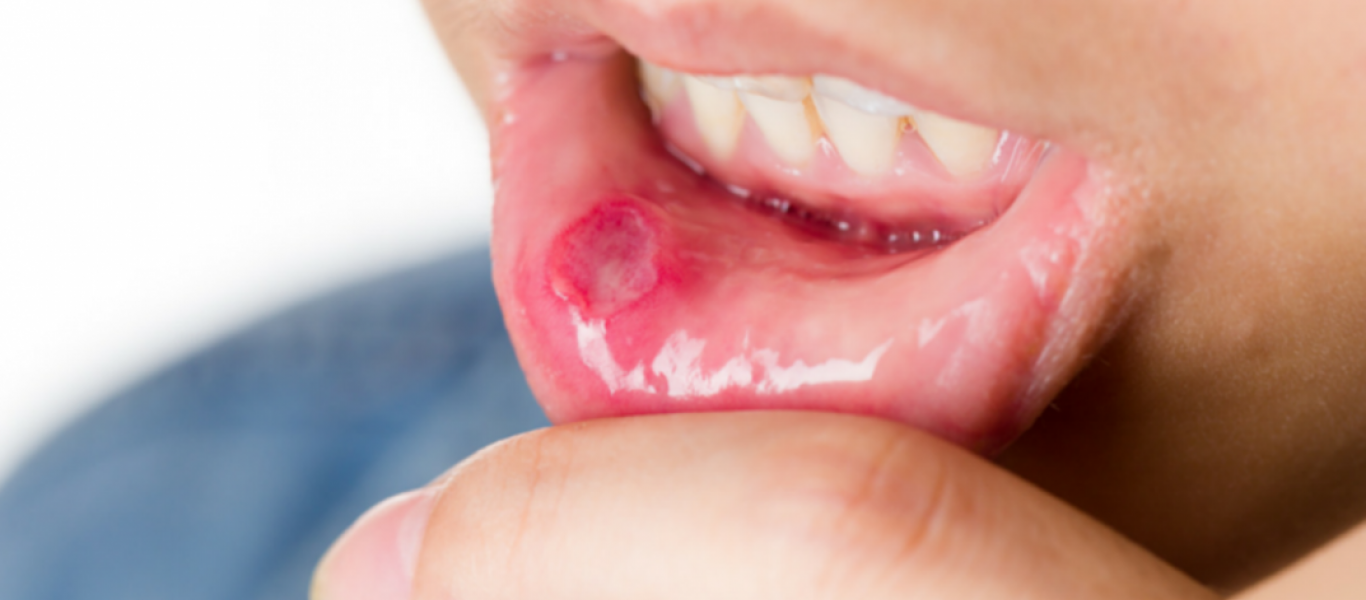 Καρκίνος του στόματος: Προσοχή στα «αθώα» συμπτώματα