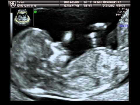 Έβγαλαν αγέννητο μωρό για να το χειρουργήσουν και το τοποθέτησαν ξανά στη μήτρα!