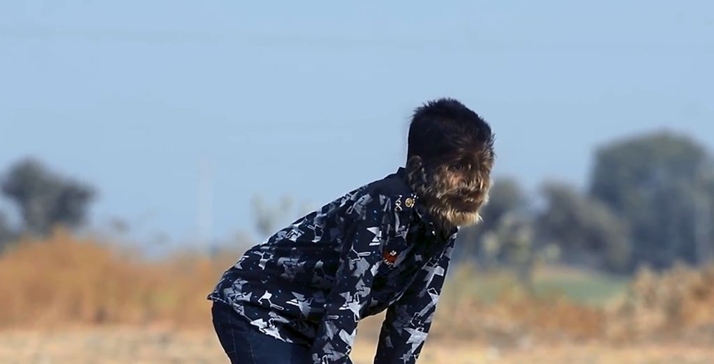 Συγκλονίζει το 13χρονο αγόρι «λυκάνθρωπος»: «Με λένε πίθηκο – Δείτε πώς είμαι» [φωτό]