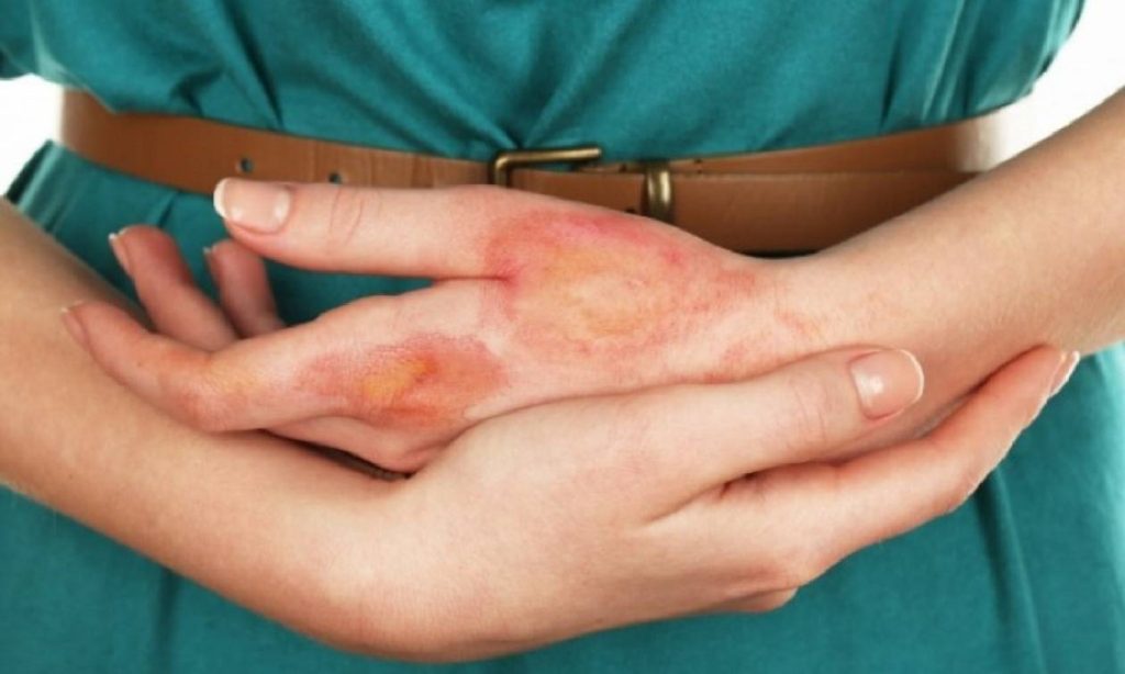 Έτσι αντιμετωπίζεται σωστά ένα έγκαυμα