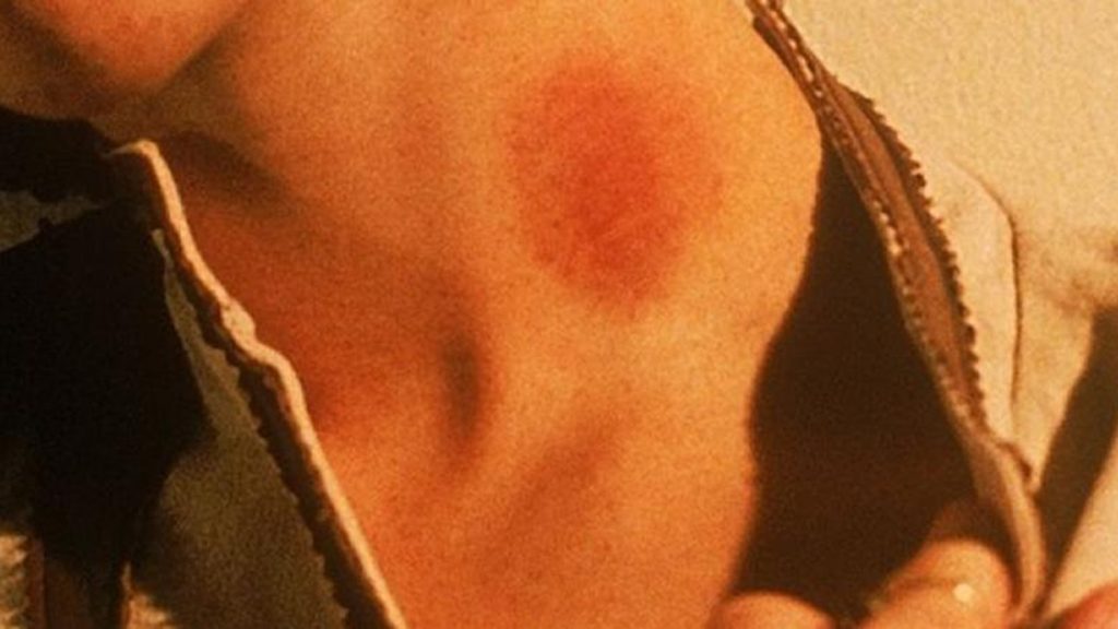 Έτσι εξαφανίζονται τα… σημάδια στο λαιμό