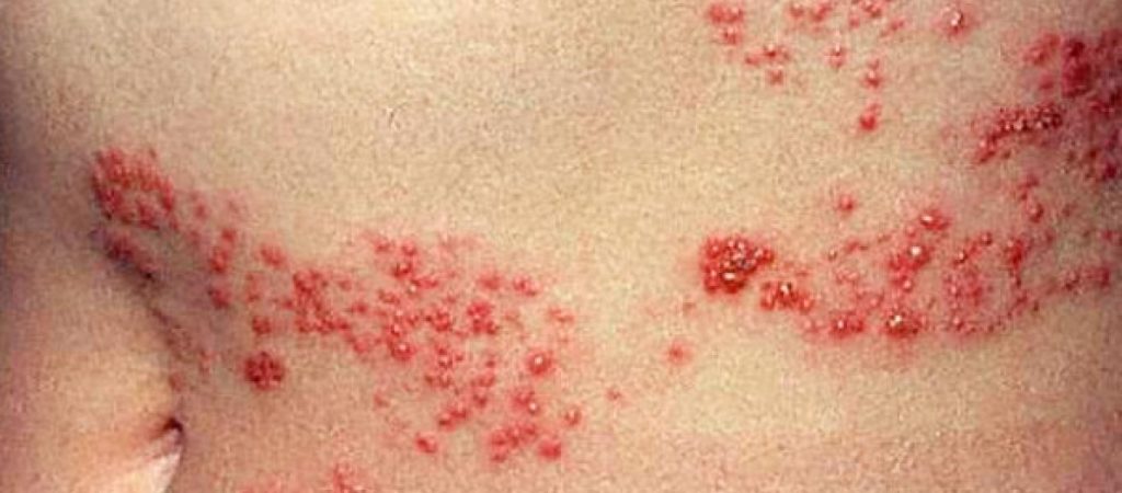 Έρπης ζωστήρας: Συμπτώματα και τι πρέπει να κάνετε