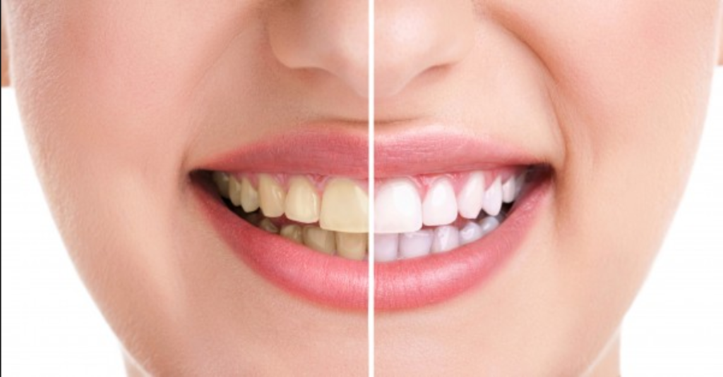 7 κακές συνήθειες που καταστρέφουν τα δόντια