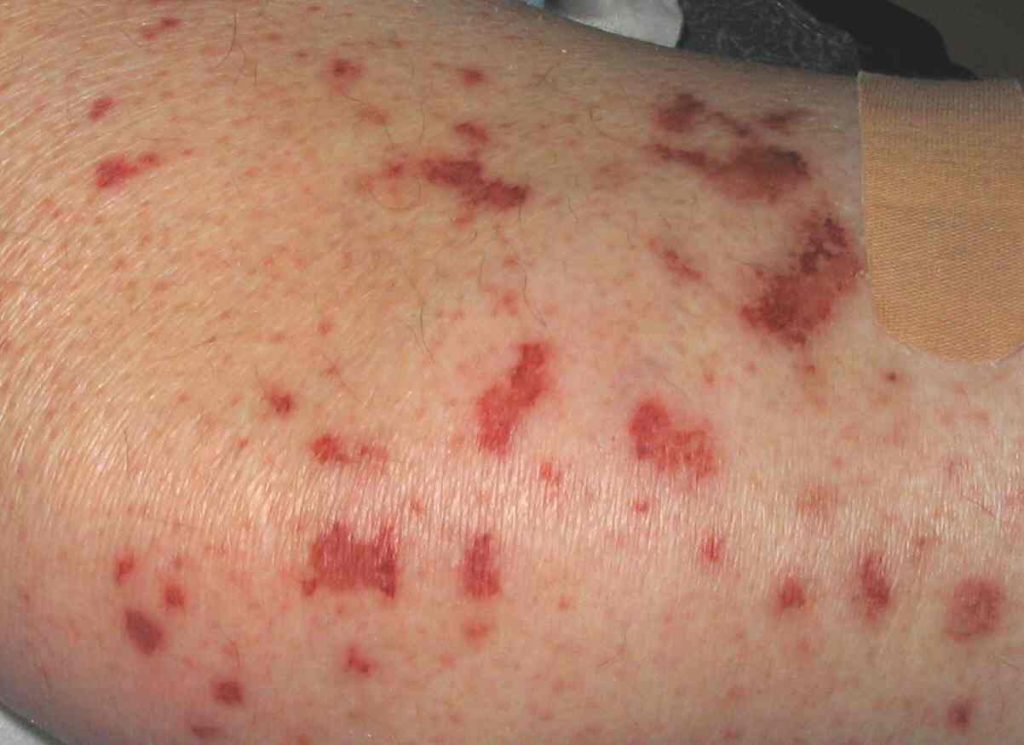 Σταφυλόκοκκος: Συμπτώματα, αίτια, θεραπεία και πρόληψη