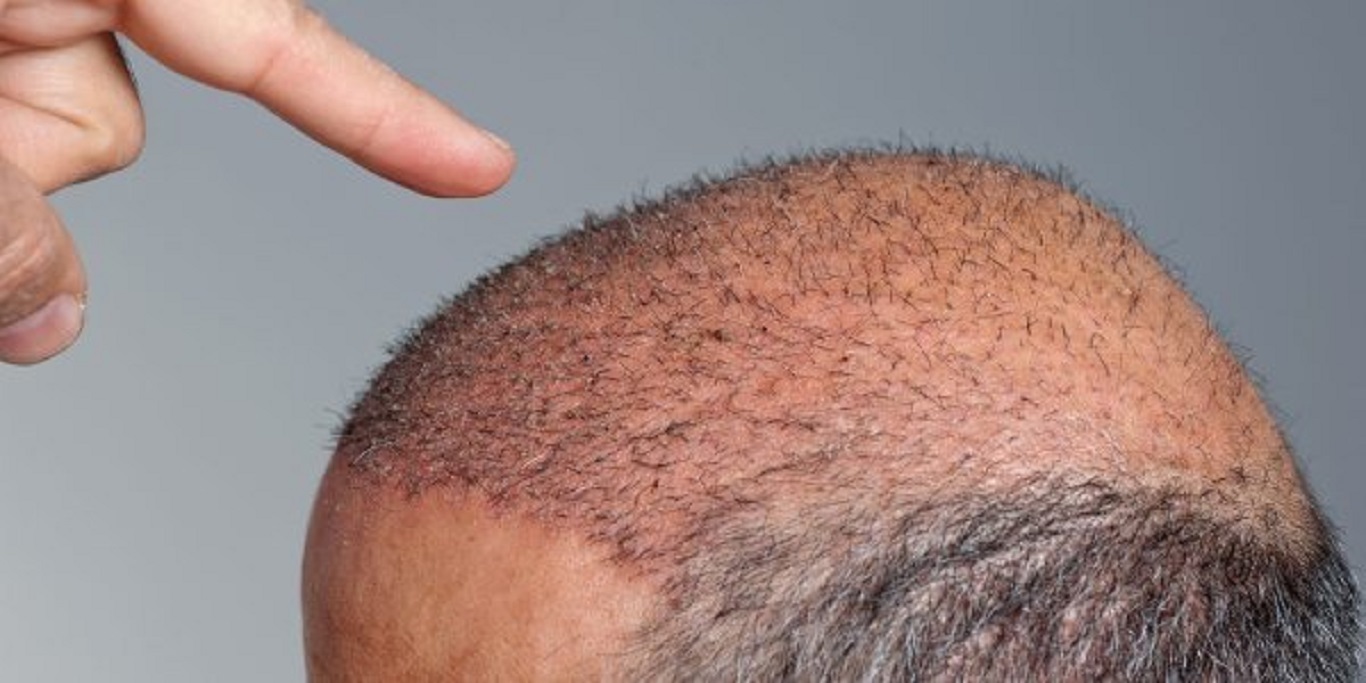 Επιχειρηματίας απεβίωσε μετά από επέμβαση μεταμόσχευσης μαλλιών