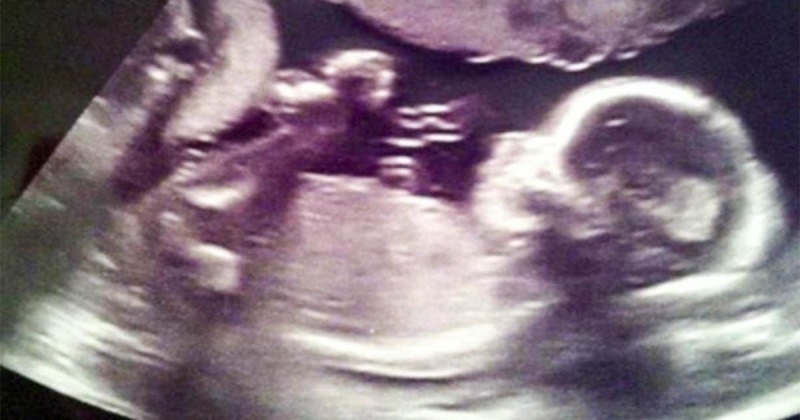 Οι γιατροί δεν παρατήρησαν κάτι στο υπερηχογράφημα – Ο πατέρας όμως είδε έναν άγγελο