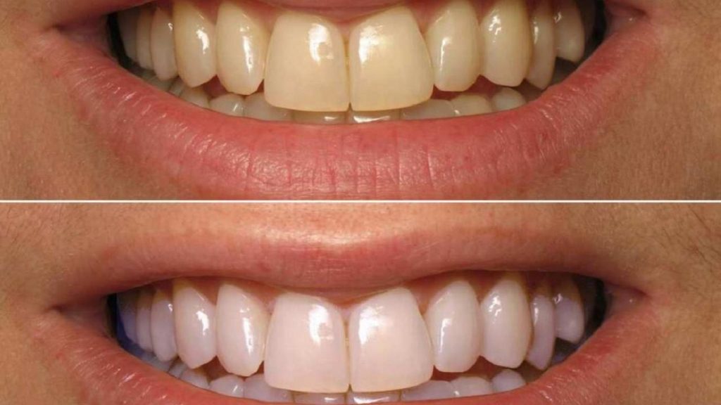Έντεκα εύκολοι τρόποι για να απαλλαγείτε από τα κίτρινα δόντια
