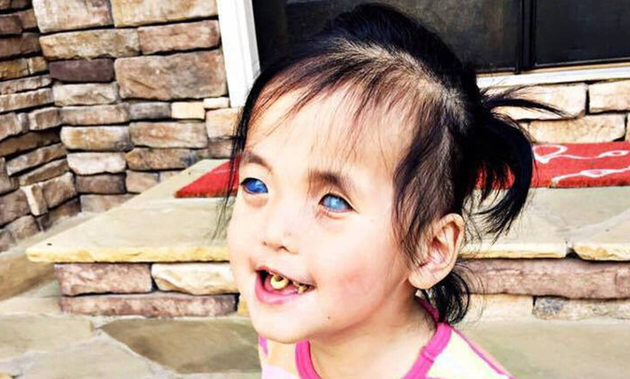 Συγκινεί η 5χρονη με τα «κρυστάλλινα» μάτια – Της τα αφαίρεσαν για να «λυτρωθεί» (φώτο-βίντεο)