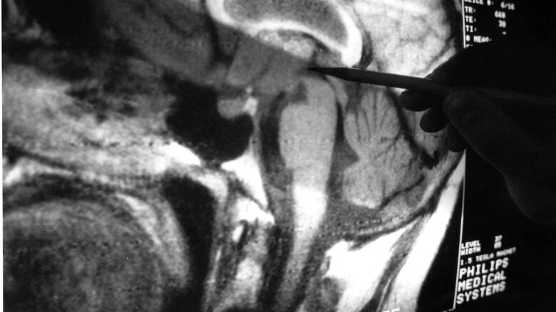 Η επαναστατική περίπτωση του ανθρώπου με «δύο εγκεφάλους» (φώτο)