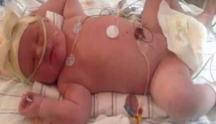 Έτσι είναι σήμερα το γιγάντιο μωρό που έγινε θέμα στις ειδήσεις το 1983 (βίντεο)