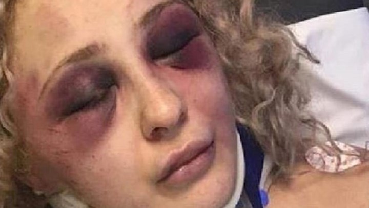 Γυναίκα χαροπαλεύει στην Εντατική μετά τον άγριο ξυλοδαρμό από τον πρώην σύντροφό της (φωτό)