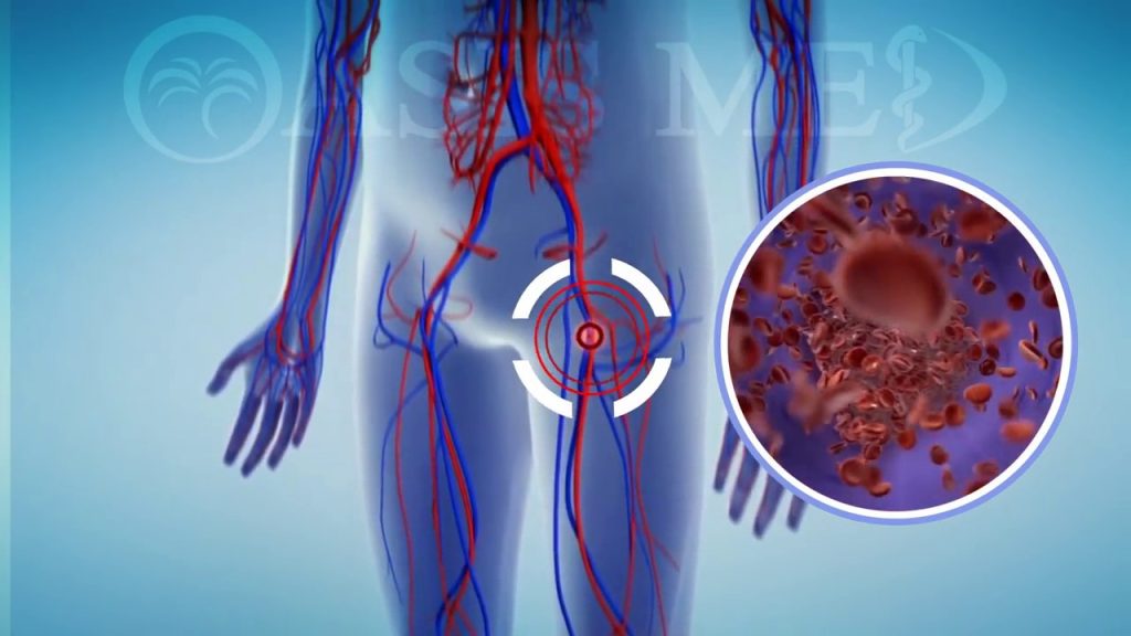 Φλεβική θρόμβωση: Ποιοι κινδυνεύουν από τον «σιωπηλό δολοφόνο» (φωτό)