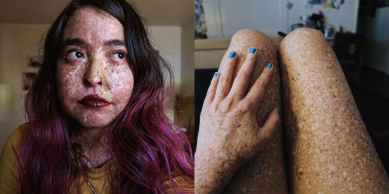 Η 26χρονη blogger που δεν μπορεί να βγει στο φως του ήλιου λόγω σοβαρής δερματικής πάθησης