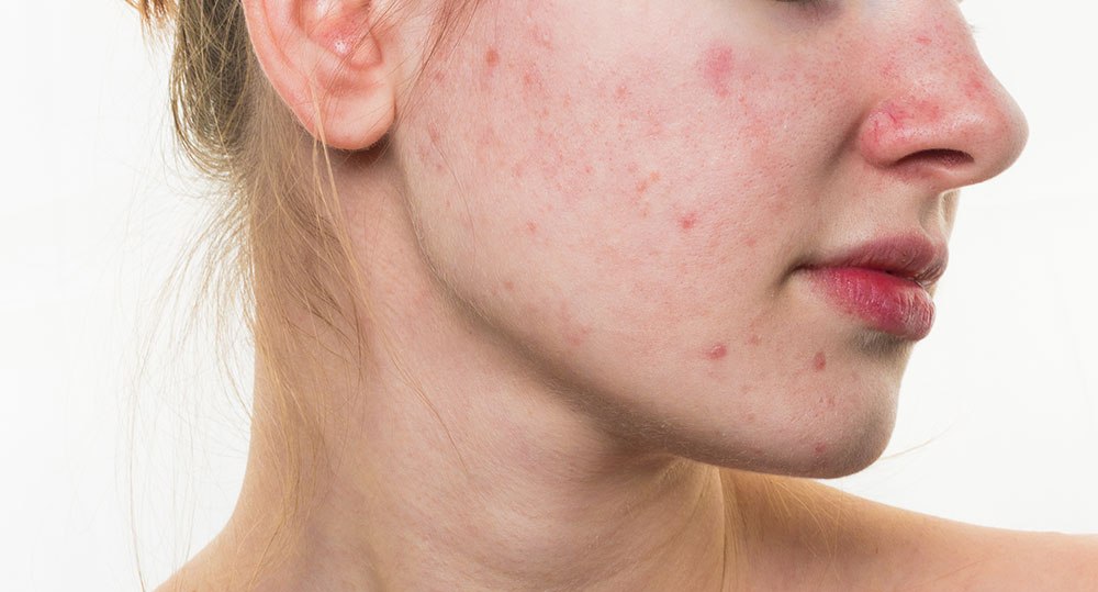 Aντιμετωπίζεται η ακμή των ενηλίκων;