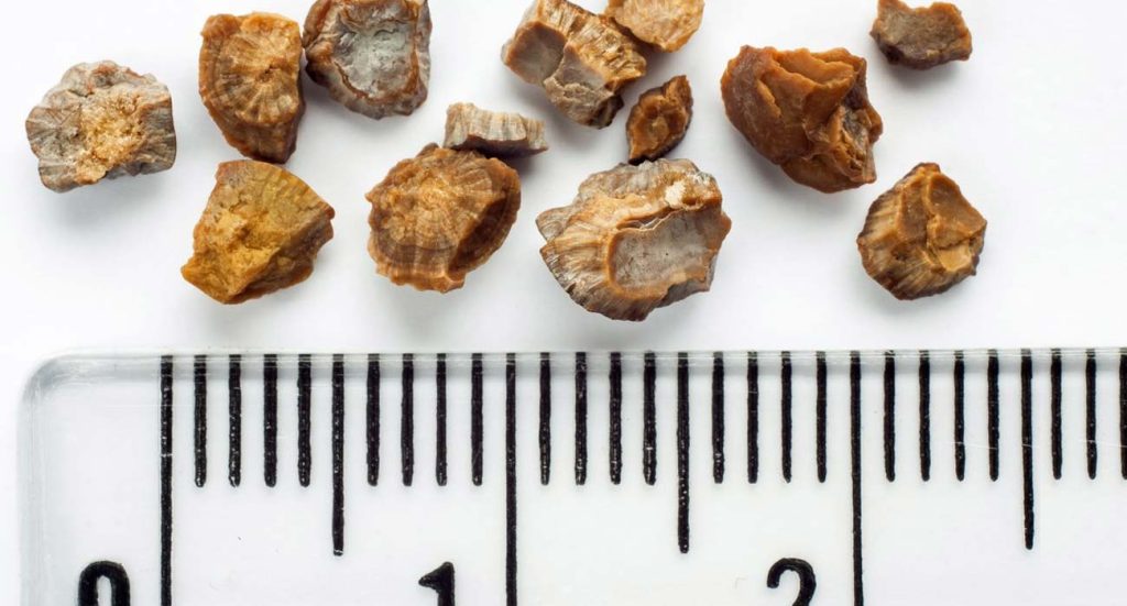 Νεφρολιθίαση: Τι να τρώτε για να αποφύγετε την πέτρα στο νεφρό