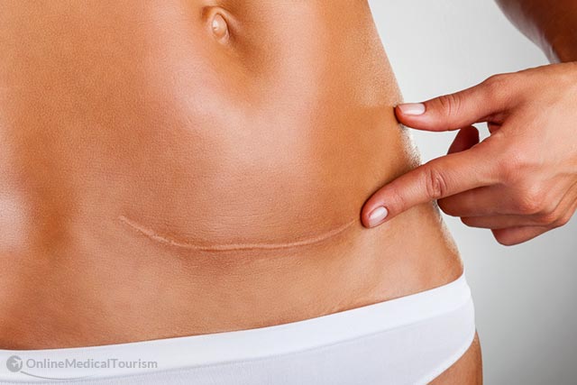 Καρκίνος ωοθηκών: Τα γονίδια που αυξάνουν τον κίνδυνο