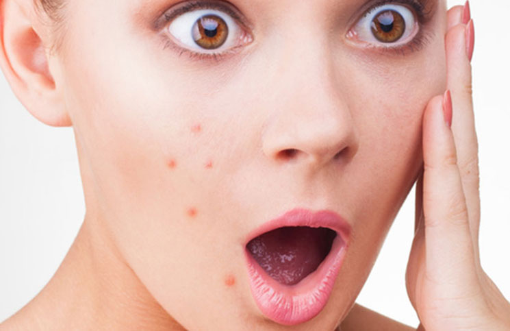 Γιατί βγαίνει πάντα σπυράκι στο ίδιο σημείο;