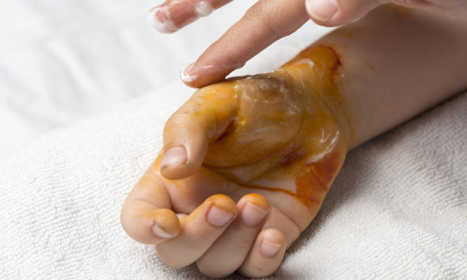 Έχεις καεί; – Με αυτήν την αλοιφή θα σου περάσει άμεσα