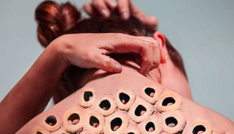 Τι είναι η τρυποφοβία – Ποιοι το έχουν