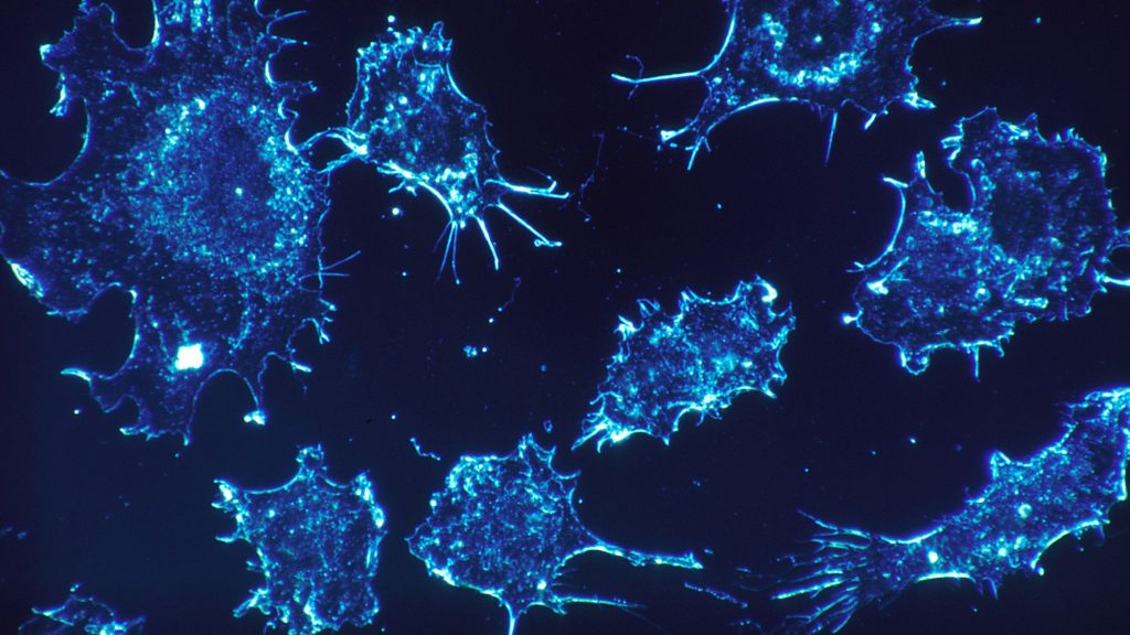 Φλεγμονώδης καρκίνος: Η σπανιότατη μορφή της «επάρατης νόσου» – Δεν εντοπίζεται με μαστογραφία! (φωτό, βίντεο)