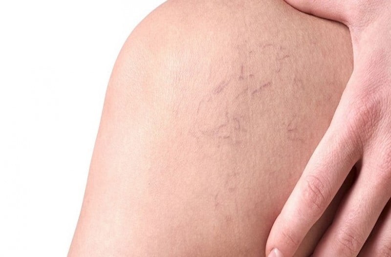 Φλεβίτιδα: Αίτια και συμπτώματα