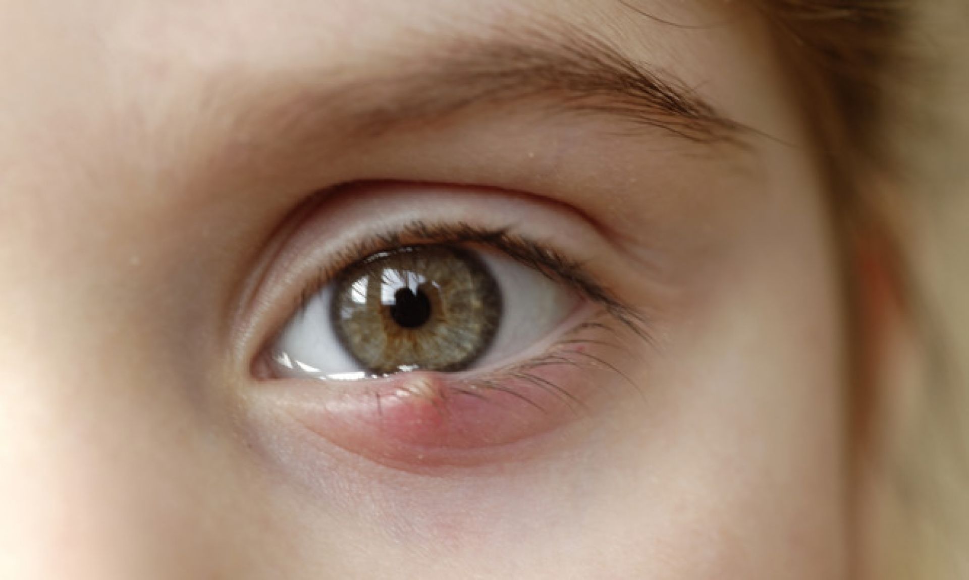 Κριθαράκι στο μάτι: Τα 5 βήματα που θα σας σώσουν
