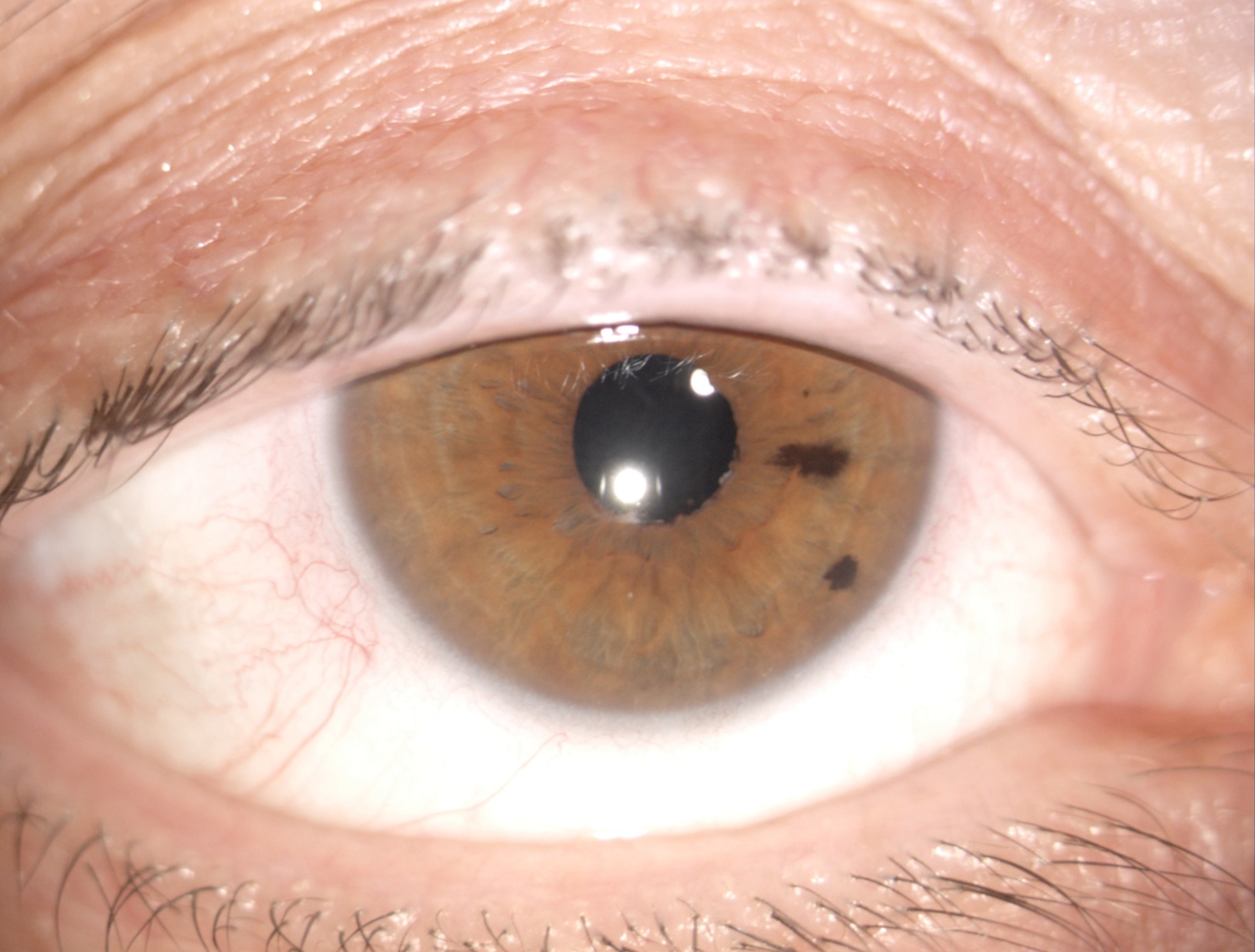 Ραγοειδίτιδα: Αίτια και συμπτώματα της πιο άγνωστης ασθένειας των ματιών