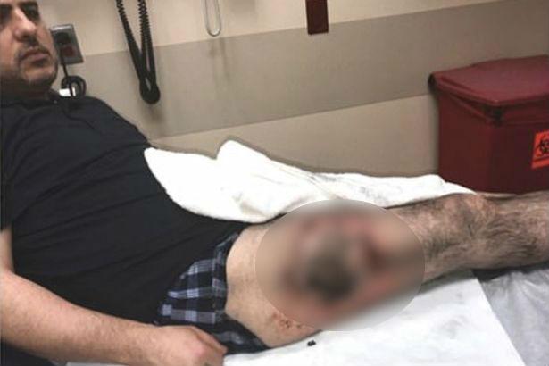 Απίστευτο: Έσκασε η μπαταρία στην τσέπη του και του έκαψε το πόδι (φωτο)