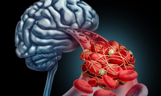 Ανεύρυσμα εγκεφάλου: Μην αγνοήσετε τα «αθώα» πρώιμα συμπτώματα