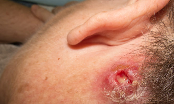 Σταφυλόκοκκος: Συμπτώματα, αίτια, θεραπεία και πρόληψη