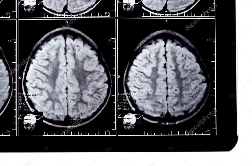 Ο 60χρονος που ζει μία φυσιολογική ζωή έχοντας μισό εγκέφαλο! – Τι ανακάλυψαν οι γιατροί