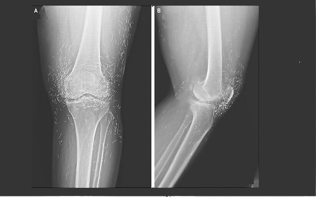 Οστεοαρθρίτιδα: Το σύμπτωμα που προμηνύει την εμφάνισή της