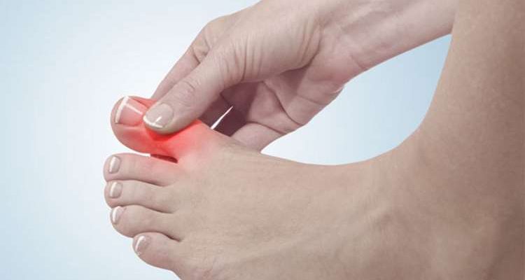 Ουρικό οξύ και διατροφή: Τι πρέπει να προσέχετε;