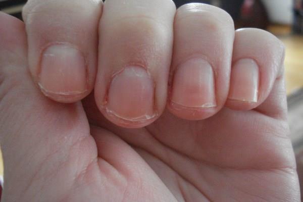 Πέντε ύπουλα προβλήματα υγείας που φαίνονται στα νύχια